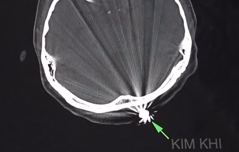 Cần Thơ: Người phụ nữ bị đầu đạn găm vào đầu khi làm vườn