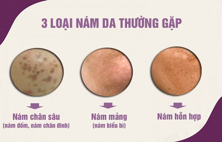Điều trị nám da Các loại nám da và cách điều trị