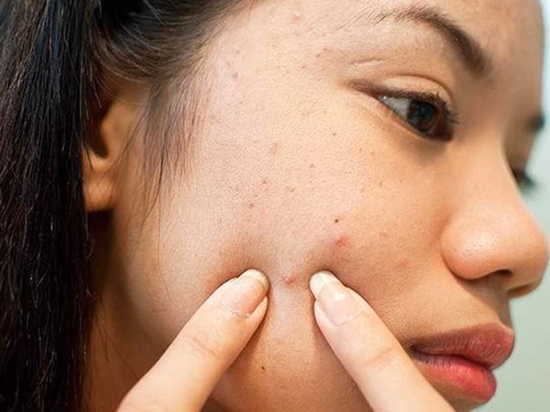 Da sau khi nặn mụn cần được chăm sóc cẩn thận Da sau khi nặn mụn cần được chăm sóc cẩn thận