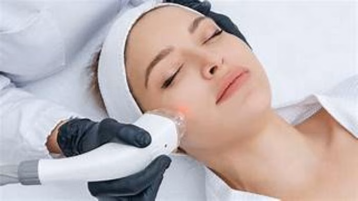 Laser trị nám Điều trị nám da bằng laser