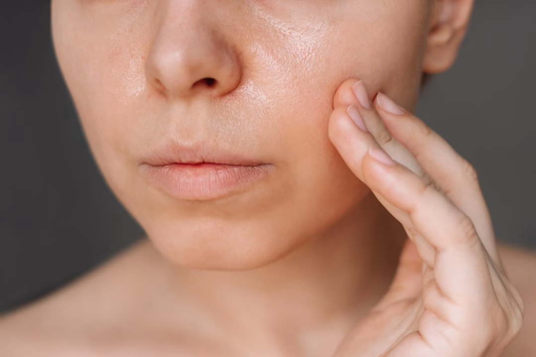 Trà xanh giúp kiểm soát dầu thừa và giảm viêm Lợi ích của trà xanh đối với làn da dầu