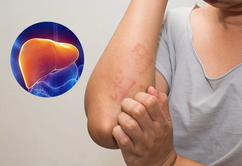 Dấu sao mạch &ndash; biểu hiện gan yếu