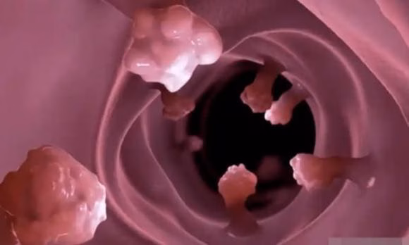 Polyp ruột Polyp ruột là những khối u mô nhô ra từ bề mặt niêm mạc ruột