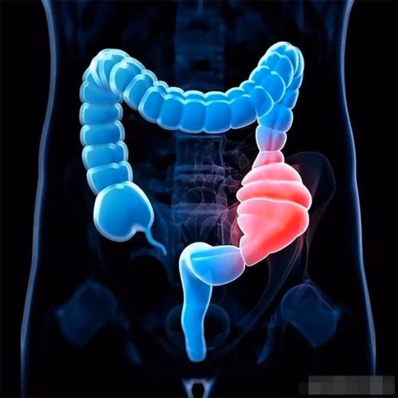 Phòng ngừa polyp ruột Phòng ngừa polyp ruột bằng lối sống lành mạnh