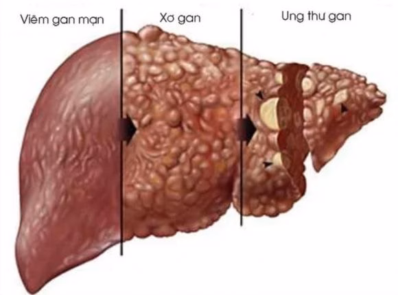Viêm gan virus mạn tính