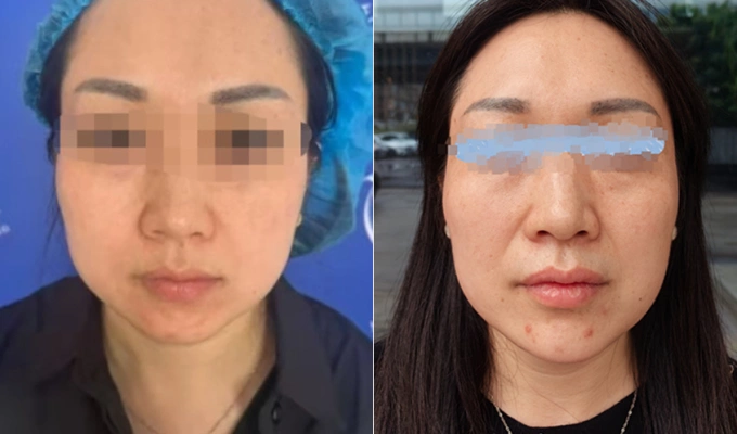 Cô Vương trước và sau khi làm đẹp Cô Vương trước và sau khi tiêm chất làm đẹp