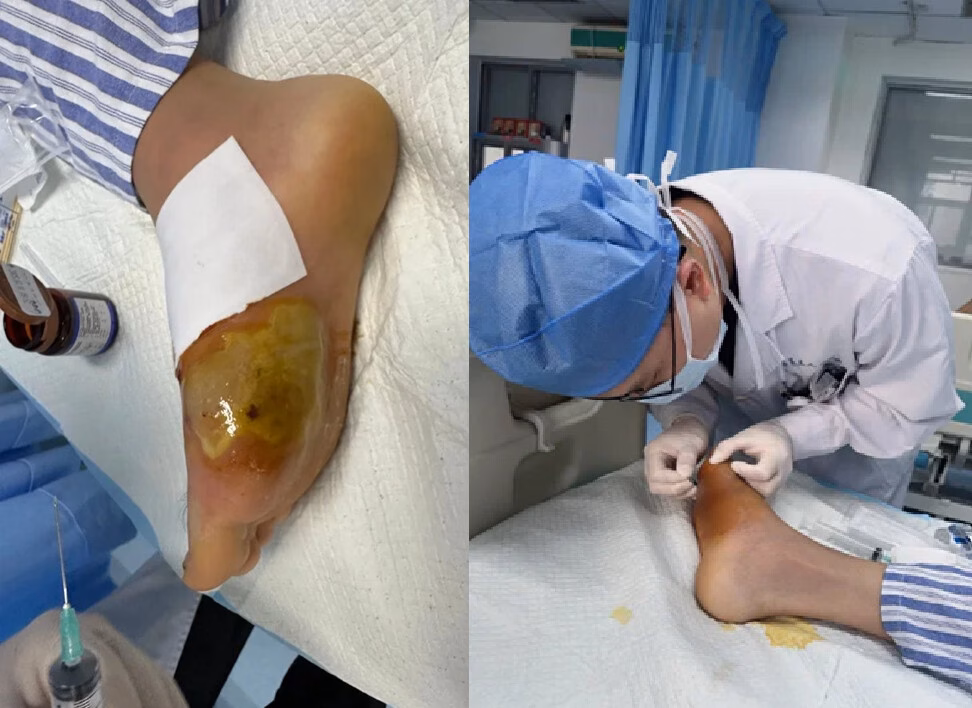 Cảnh báo nguy cơ nhiễm trùng từ vết thương do đâm phải dị vật nhỏ