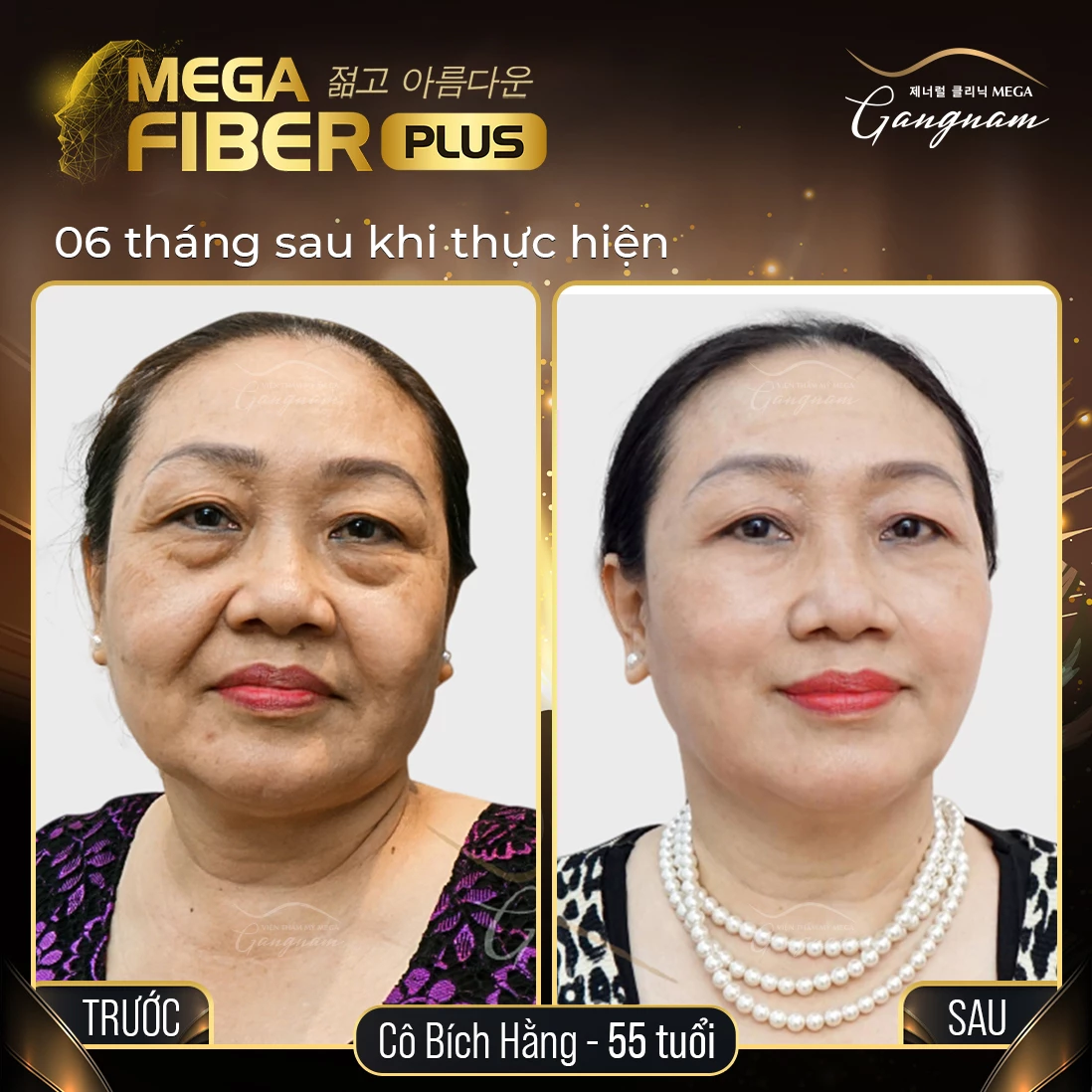 Công nghệ trẻ hóa da thế hệ mới, trẻ gấp đôi, đẹp độc bản- Mega Fiber Plus.