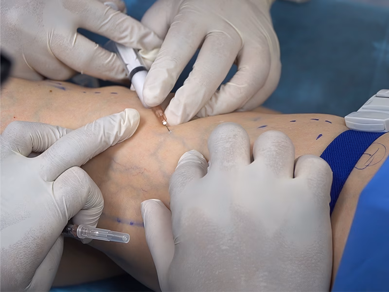 Tiêm xơ điều trị suy giãn tĩnh mạch Tiêm xơ điều trị suy giãn tĩnh mạch