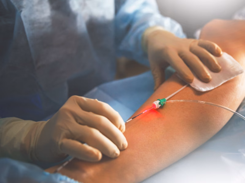 Laser nội mạch điều trị suy giãn tĩnh mạch Laser nội mạch điều trị suy giãn tĩnh mạch