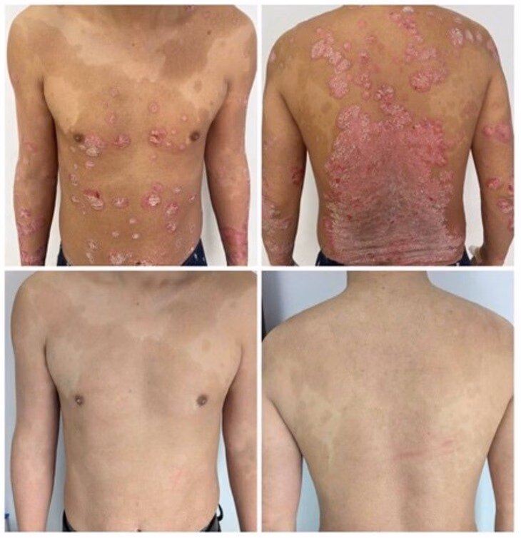 Vảy nến có thể chữa khỏi với thuốc sinh học Vảy nến có thể trị khỏi được không? - Ảnh 2.