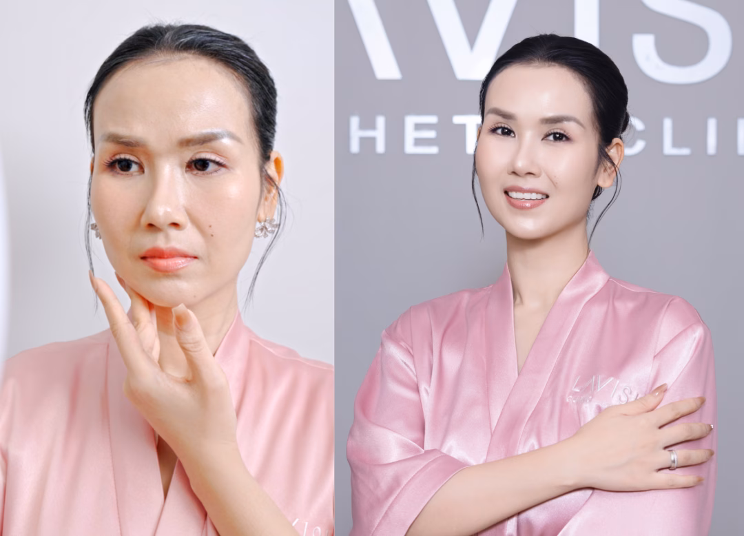Võ Hạ Trâm trước và sau trẻ hóa đa tầng bằng công nghệ cao tại Lavish Clinic - By Huyen Baby.