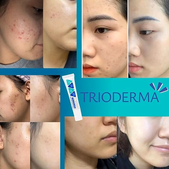 4 Kem trị mụn hiệu quả và giá rẻ cho làn da bị mụn nặng Top 4 kem trị mụn giá rẻ mà hiệu quả với cả mụn thể nặng - Ảnh 3.