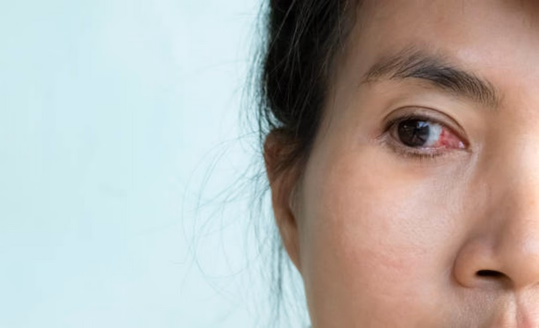 Viêm giác mạc Viêm giác mạc do đeo kính áp tròng quá lâu
