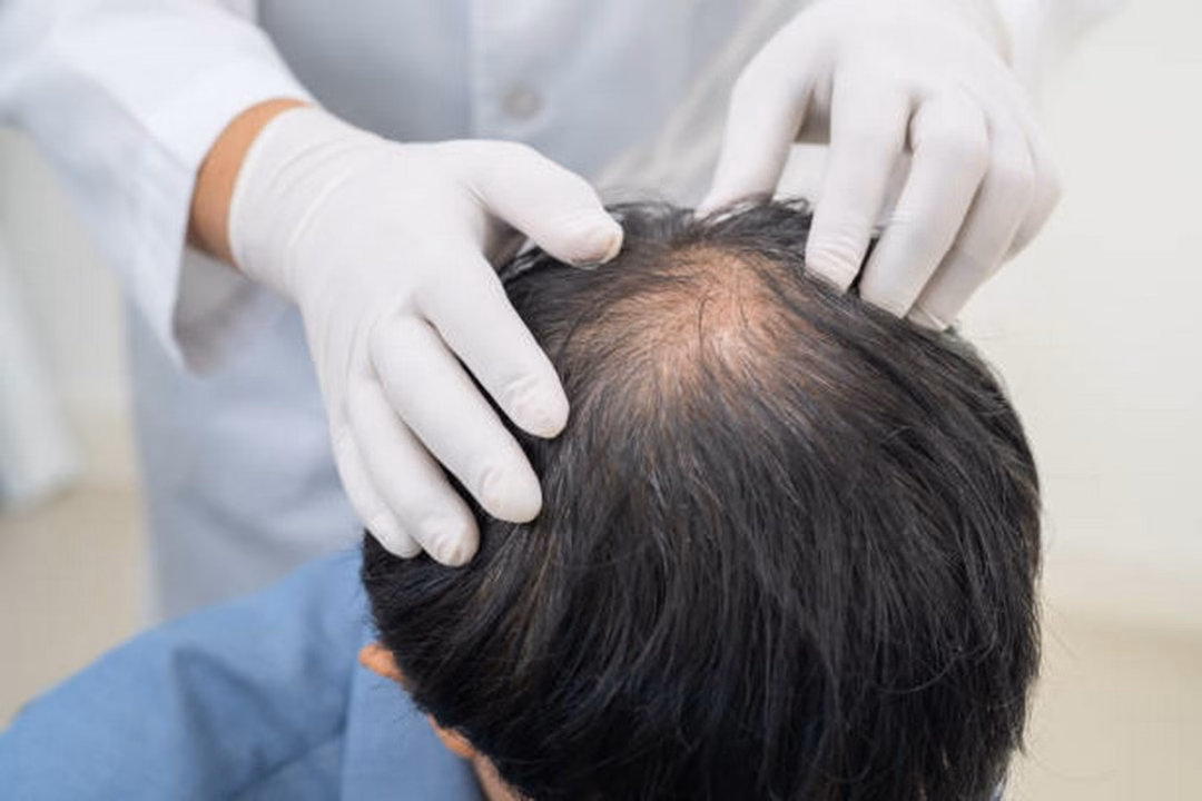 Cả nam giới và phụ nữ đều có nguy cơ bị rụng tóc ở độ tuổi 40.