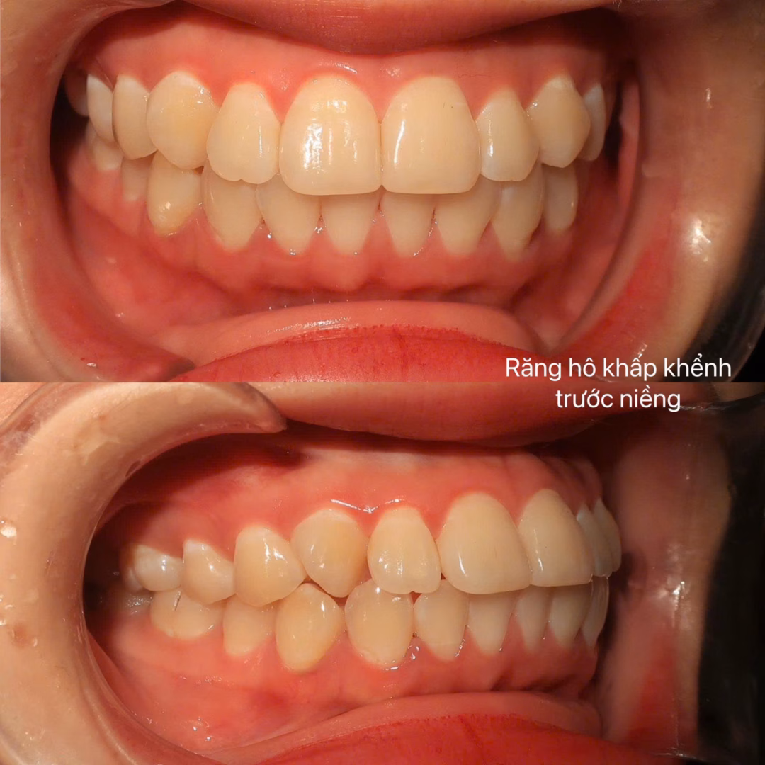 Niềng răng trong suốt Niềng răng trong suốt cho người trưởng thành