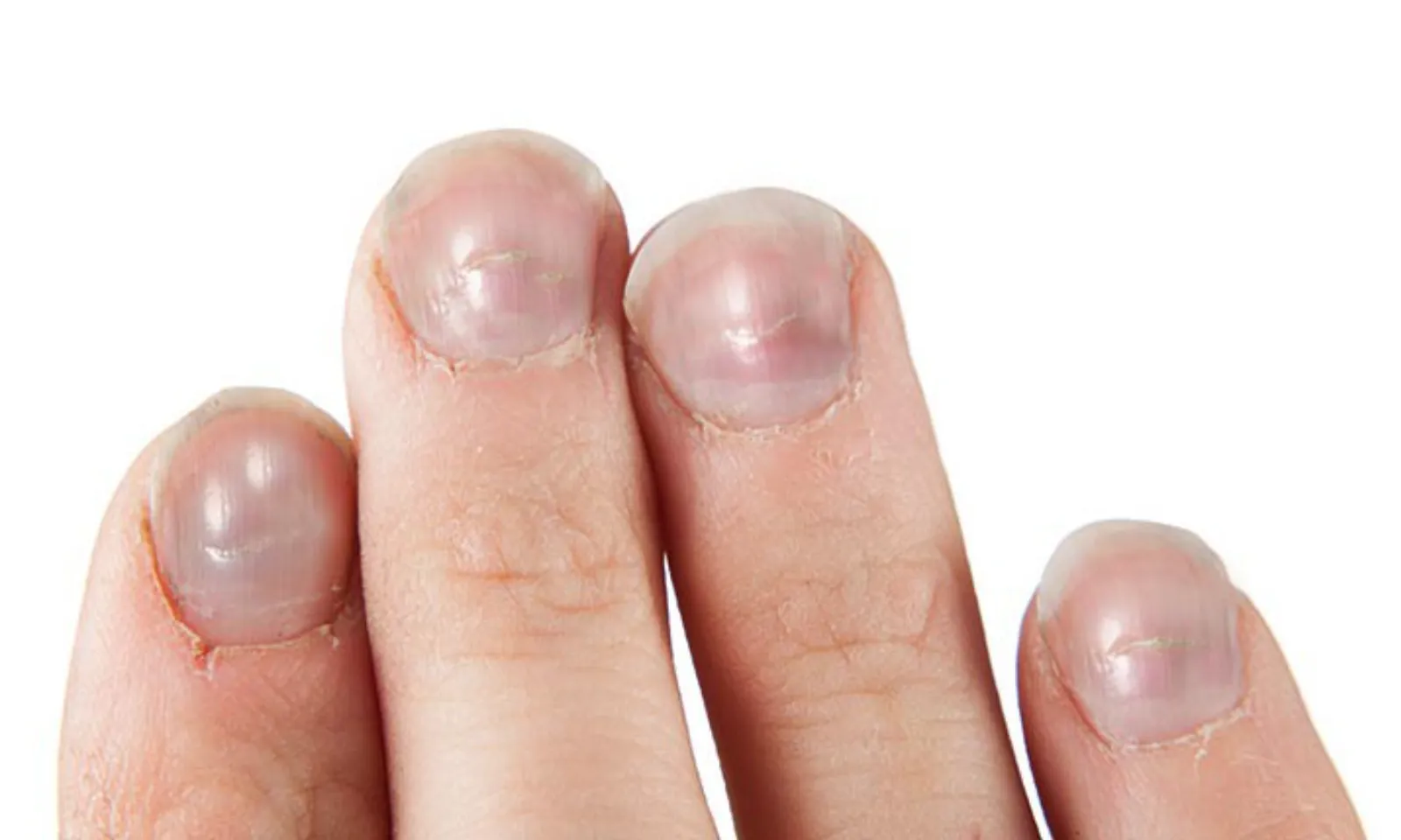 10 sự thật dinh dưỡng mọi người nên biết để sống khỏe hơn Những dấu hiệu bệnh trên móng tay báo hiệu sức khỏe của bạn