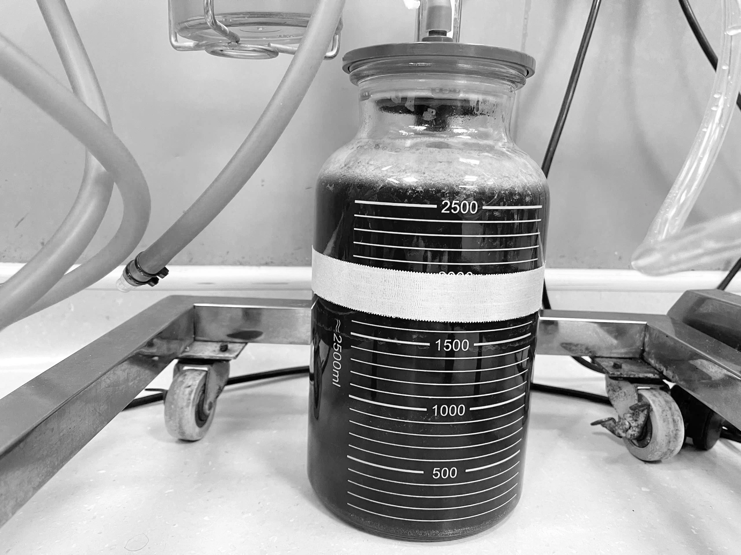Cảnh báo biến chứng từ tiêm filler không đúng cách Gần 3 lít filler, mô hoại tử... được nạo hút ra ngoài