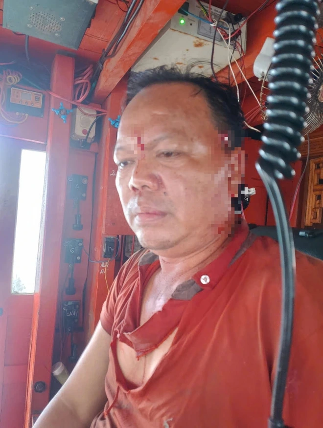 Thuyền trưởng bị hành hung trên biển khi đang đánh bắt hải sản Anh Xiền sau khi bị chém, đang vào bờ để điều trị vết thương