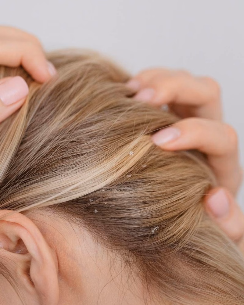Tóc Ướt Đi Ngủ: Cảnh Báo Về Nấm Đầu Và Cách Phòng Ngừa