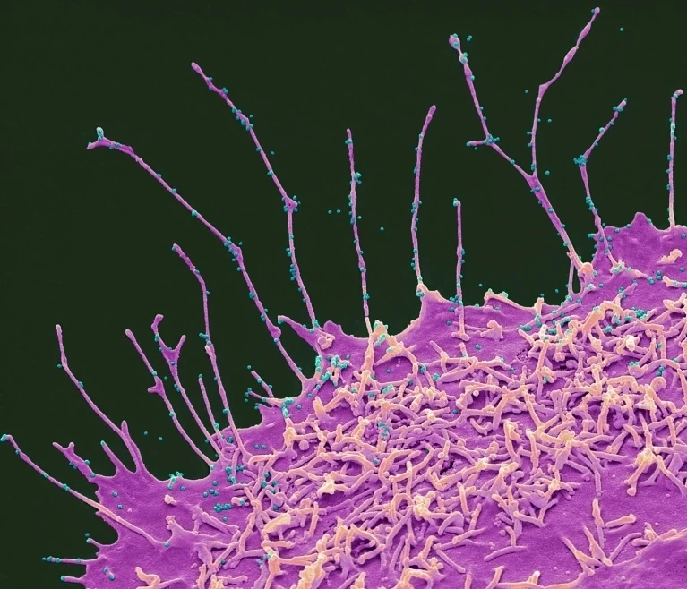 Đại dịch Covid-19 làm não bộ người khỏe mạnh lão hóa nhanh hơn Các hạt SARS-CoV-2 (màu xanh lam, được nhuộm màu nhân tạo) nảy mầm từ một tế bào (màu hồng). Những người tham gia nghiên cứu bị nhiễm virus đã mất đi sự linh hoạt về mặt tinh thần. Ảnh: Steve Gschmeissner/SPL.