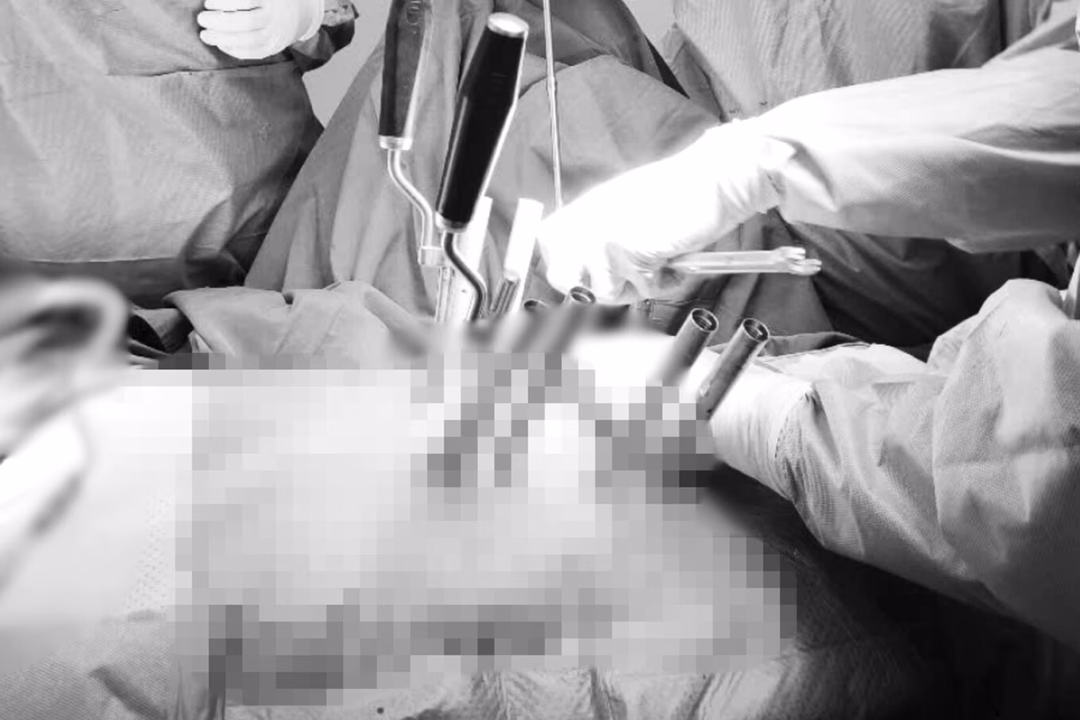 Cứu sống một phụ nữ bị gãy cột sống và hai gót chân do thang máy rơi Bệnh nhân đang dần hồi phục sức khỏe sau ca phẫu thuật. (Ảnh: BV).