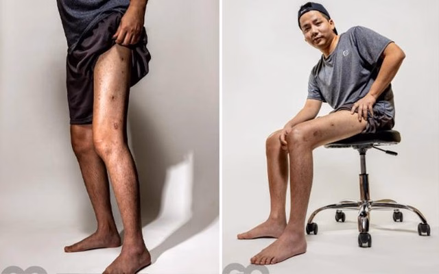 YouTuber Khoa Pug chi 3 tỷ đồng kéo chân, tăng 10cm chiều cao Vào năm 2023, Khoa Pug từng chi 5 tỷ để kéo dài chân.