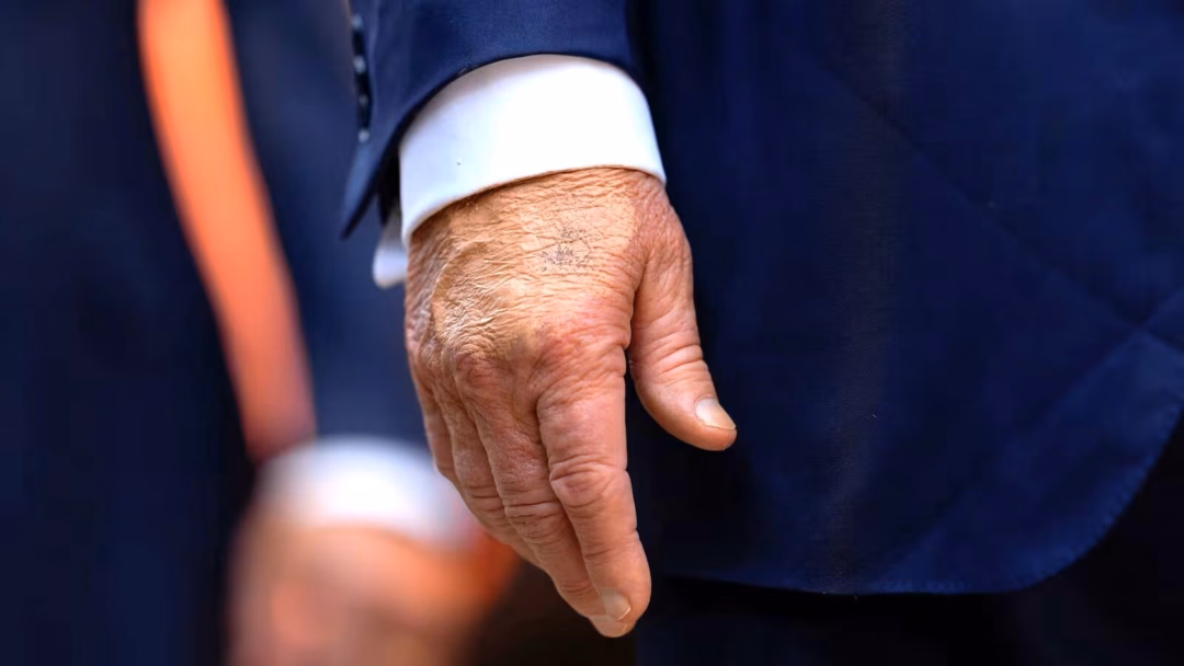 Tổng thống Mỹ và thói quen dùng son che bớt vết contusion trên tay Donald Trump, his bruised hand, and Federal Reserve Chair Jerome Powell.