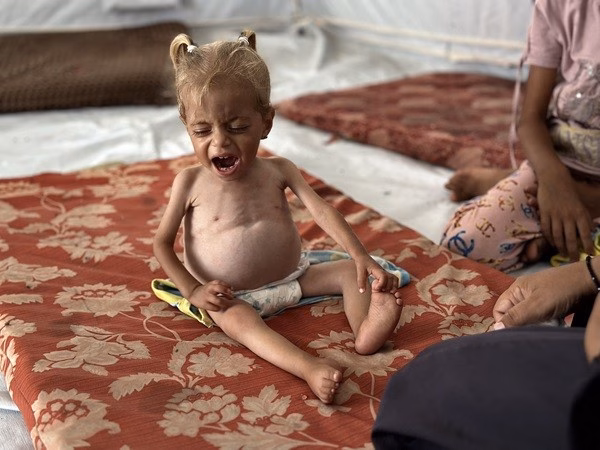 Thảm họa đói kém ở Gaza: Trẻ em Palestine thiệt mạng vì suy dinh dưỡng nghiêm trọng Theo Tiến sĩ Munir al-Boursh, “Zeinab đã chết do biến chứng của tình trạng suy dinh dưỡng nghiêm trọng. Bé bị bỏ mặc cho đến khi chỉ còn da bọc xương".