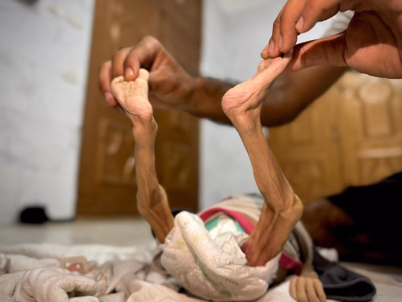 Thảm họa đói kém ở Gaza: Trẻ em Palestine thiệt mạng vì suy dinh dưỡng nghiêm trọng “Zeinab ra vào bệnh viện liên tục trong ba tháng qua. Tôi phải đi bộ hơn 30 phút vì không có phương tiện di chuyển. Thời tiết thì nóng, nhưng tôi vẫn tiếp tục đi mặc dù đói và không có nước”, mẹ của cô bé, Israa Abu Halib, nói.