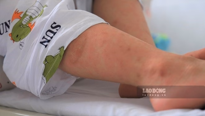 Thống k&ecirc; số ca nghi sởi tại Việt Nam qu&yacute; I/2026 cho thấy diễn biến phức tạp của dịch bệnh