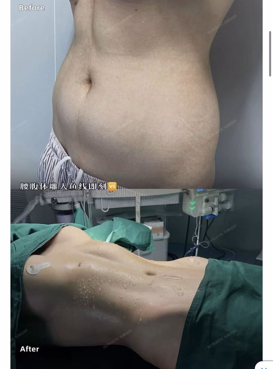 Xu hướng l&agrave;m đẹp kinh dị: v&ograve;ng eo con kiến &ndash; Ảnh 1